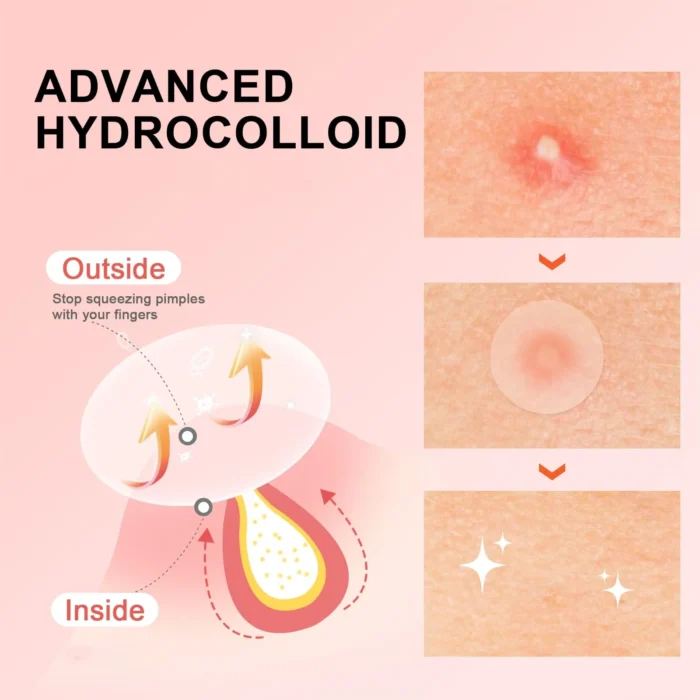 Hydrocolloid Acne Patches: Essential acne patches for every occasion | Invisible, breathable, and traceless, gentle on skin, wat - Image 3