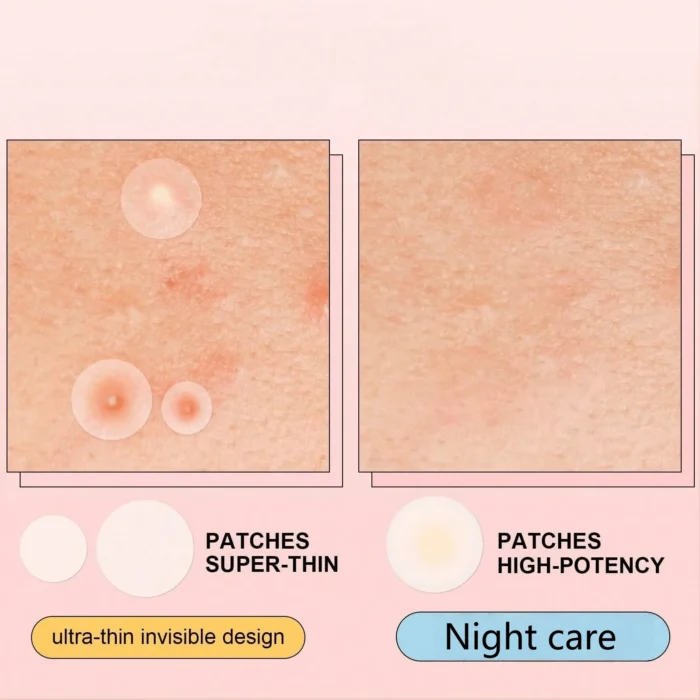 Hydrocolloid Acne Patches: Essential acne patches for every occasion | Invisible, breathable, and traceless, gentle on skin, wat - Image 5
